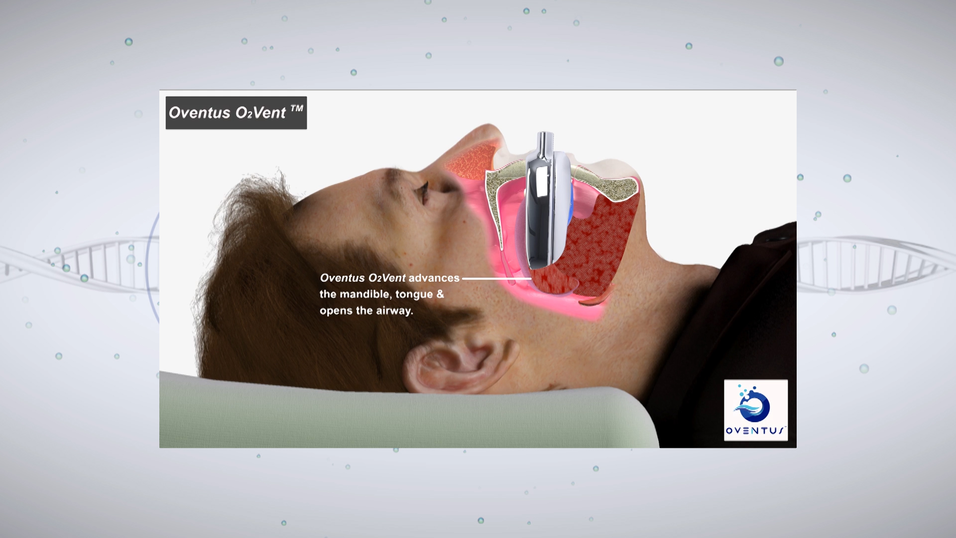 Beyond the Barriers: Obstructive Sleep Apnea Treatments - Access Health