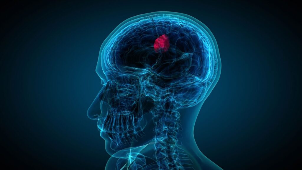Access Health Highlights: Brain Tumor Awareness
